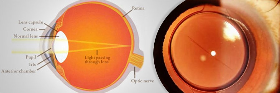 Cataract