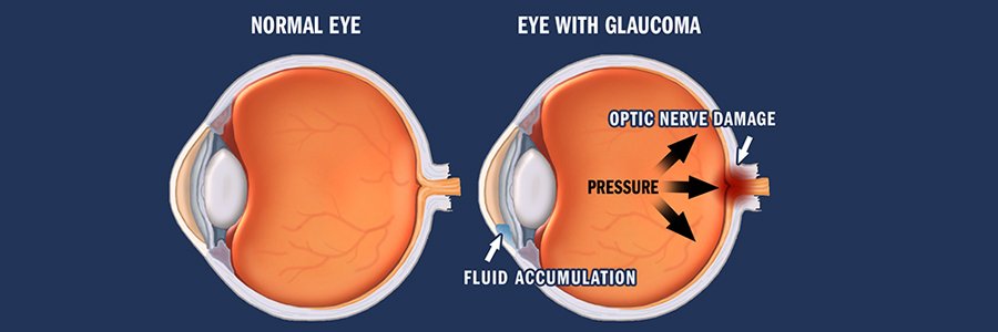 Glaucoma